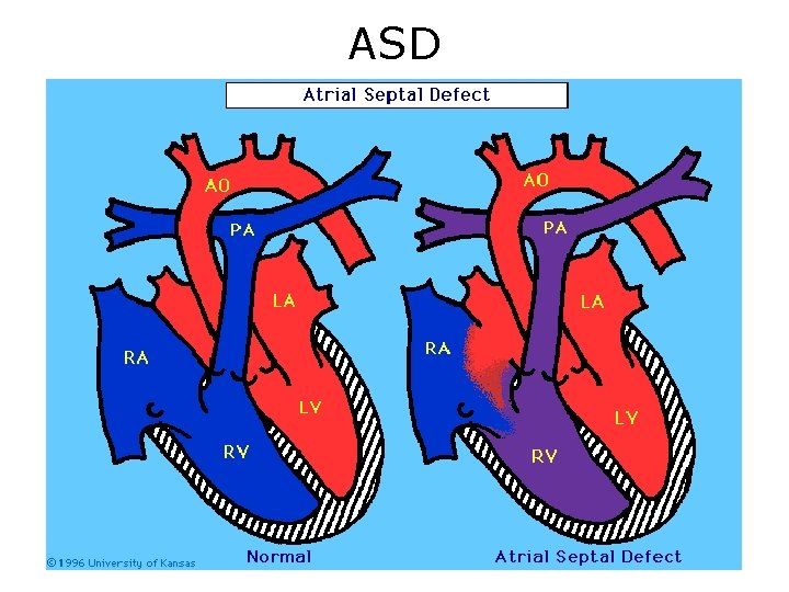 ASD 