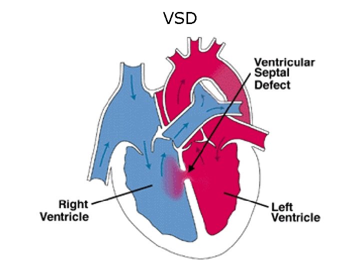 VSD VSD