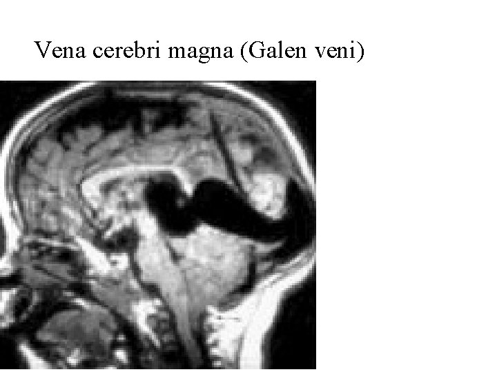 Vena cerebri magna (Galen veni) 