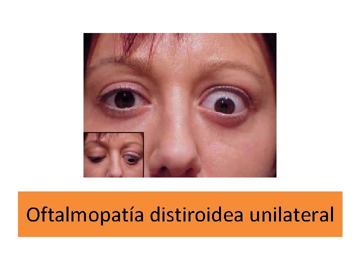 Oftalmopatía distiroidea unilateral 