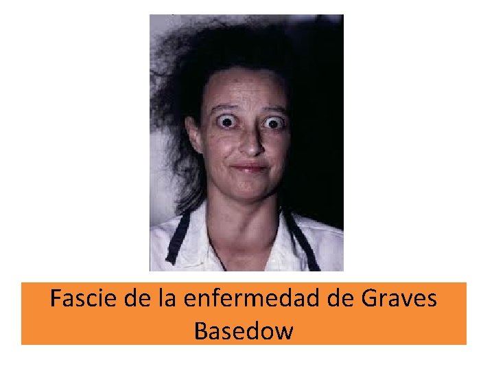 Fascie de la enfermedad de Graves Basedow 