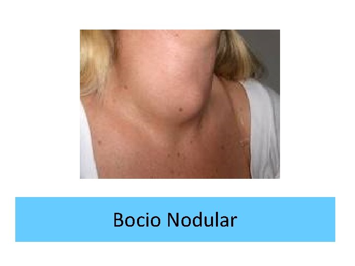 Bocio Nodular 