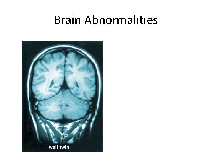 Brain Abnormalities 