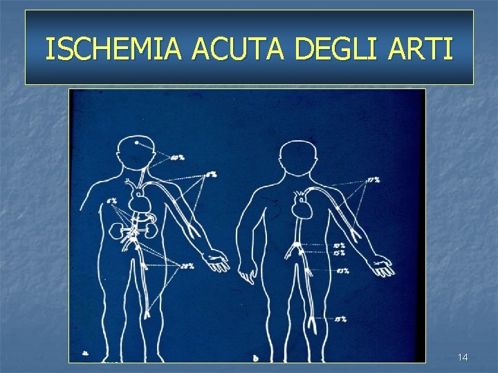 ISCHEMIA ACUTA DEGLI ARTI 14 