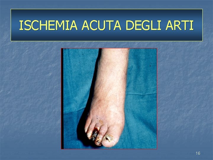 ISCHEMIA ACUTA DEGLI ARTI 16 