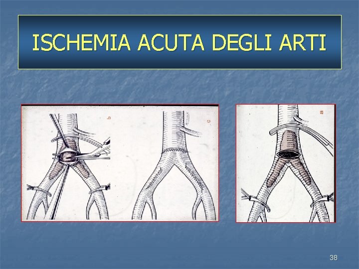 ISCHEMIA ACUTA DEGLI ARTI 38 