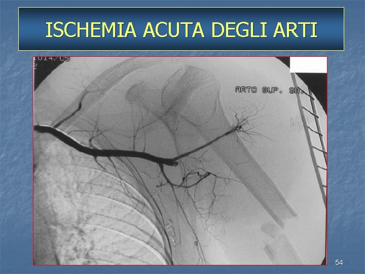 ISCHEMIA ACUTA DEGLI ARTI 54 