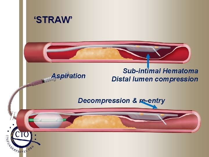 ‘STRAW’ Aspiration Sub-intimal Hematoma Distal lumen compression Decompression & re-entry 