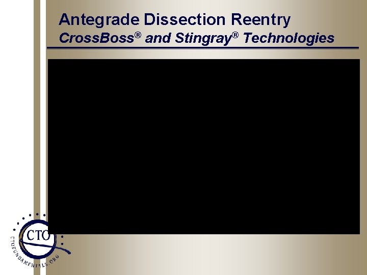 Antegrade Dissection Reentry Cross. Boss® and Stingray® Technologies 