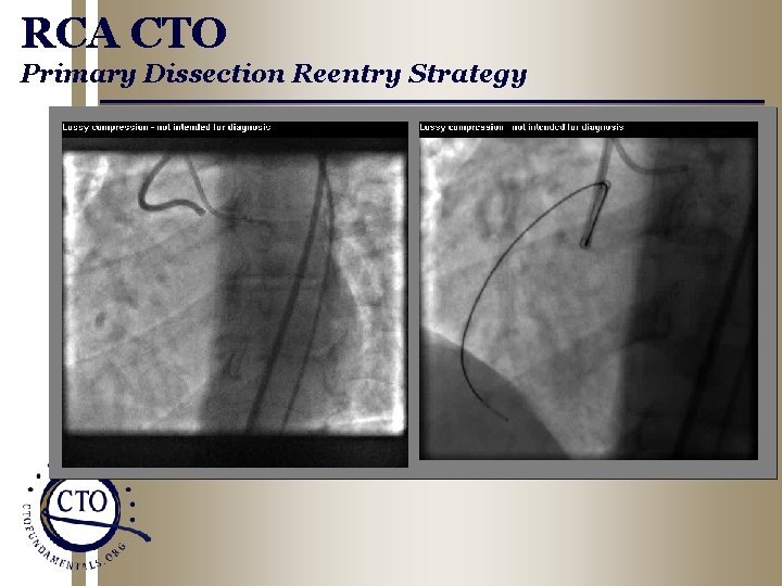 RCA CTO Primary Dissection Reentry Strategy 