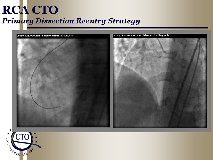 RCA CTO Primary Dissection Reentry Strategy 