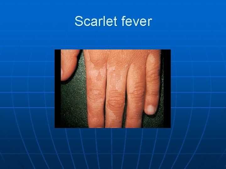 Scarlet fever 