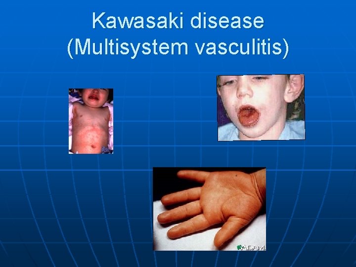 Kawasaki disease (Multisystem vasculitis) 