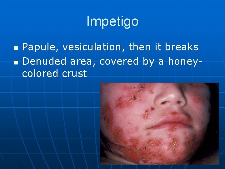 Impetigo n n Papule, vesiculation, then it breaks Denuded area, covered by a honeycolored
