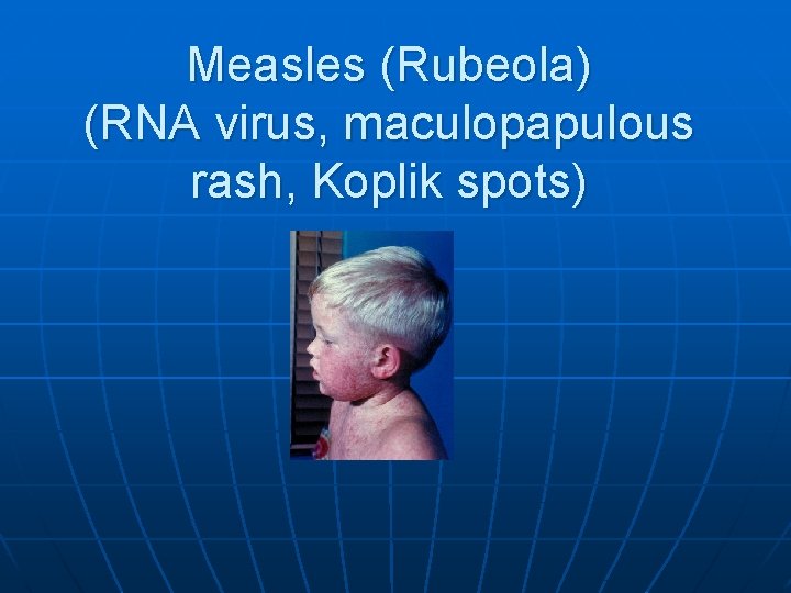 Measles (Rubeola) (RNA virus, maculopapulous rash, Koplik spots) 