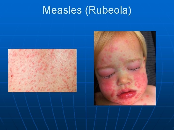 Measles (Rubeola) 