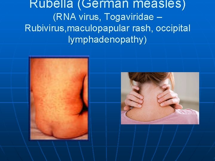 Rubella (German measles) (RNA virus, Togaviridae – Rubivirus, maculopapular rash, occipital lymphadenopathy) 