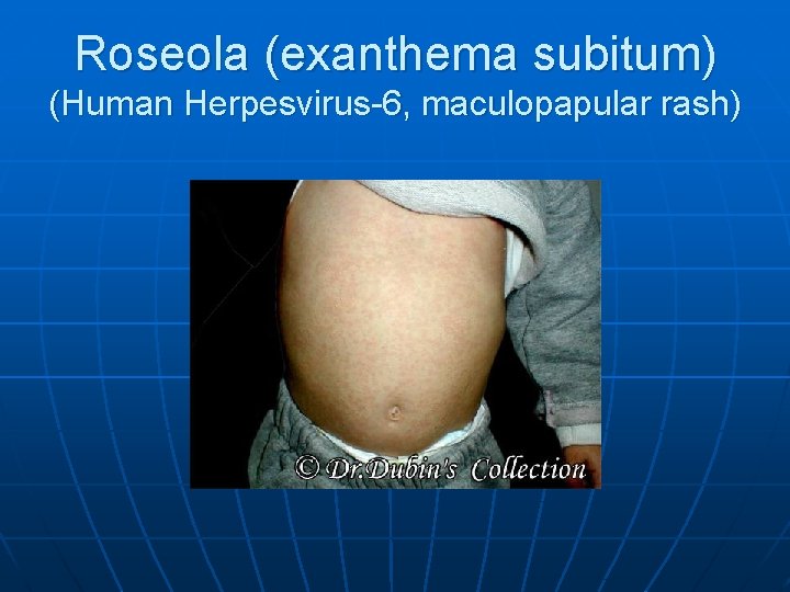 Roseola (exanthema subitum) (Human Herpesvirus-6, maculopapular rash) 