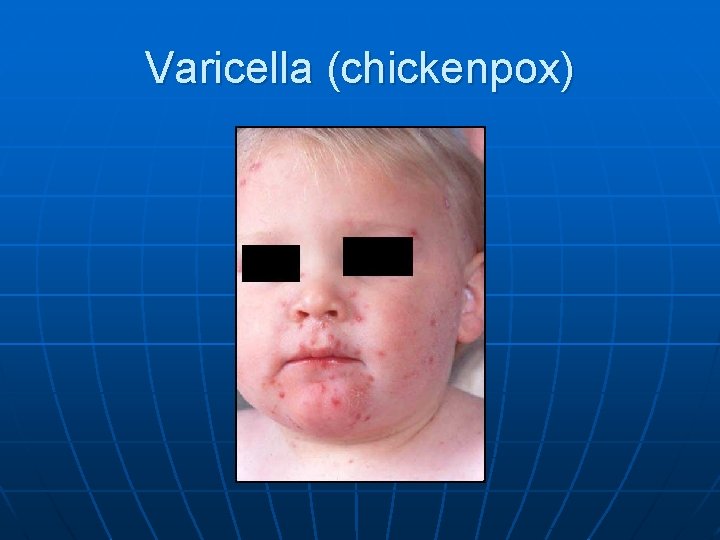 Varicella (chickenpox) 