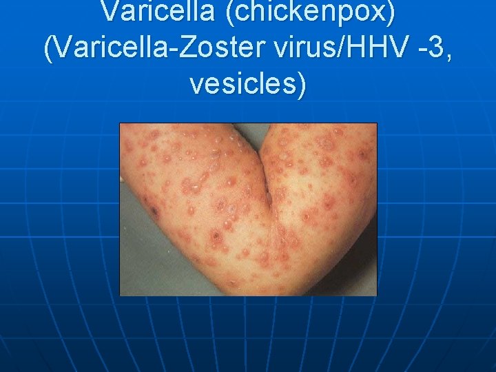 Varicella (chickenpox) (Varicella-Zoster virus/HHV -3, vesicles) 