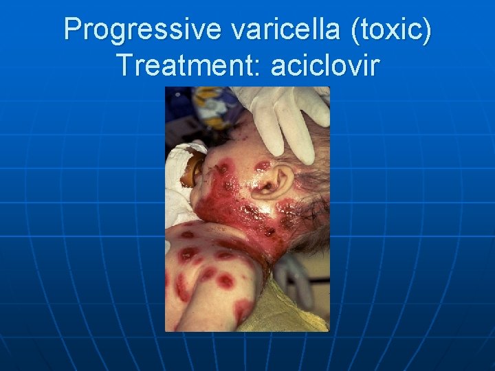 Progressive varicella (toxic) Treatment: aciclovir 