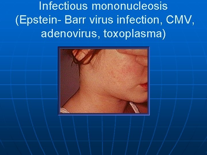 Infectious mononucleosis (Epstein- Barr virus infection, CMV, adenovirus, toxoplasma) 