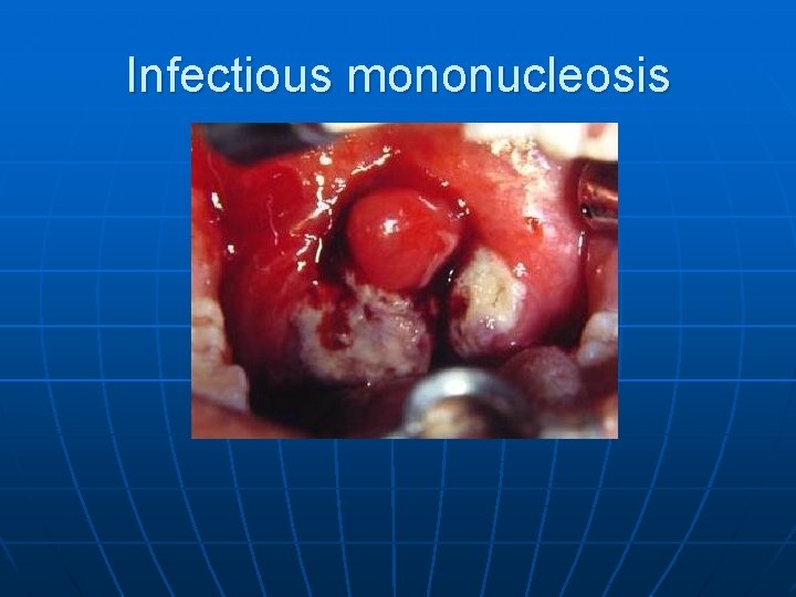 Infectious mononucleosis 