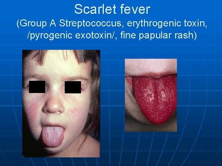 Scarlet fever (Group A Streptococcus, erythrogenic toxin, /pyrogenic exotoxin/, fine papular rash) 