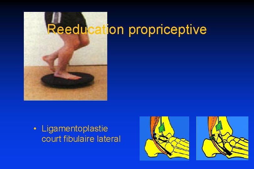 Reeducation propriceptive • Ligamentoplastie court fibulaire lateral 