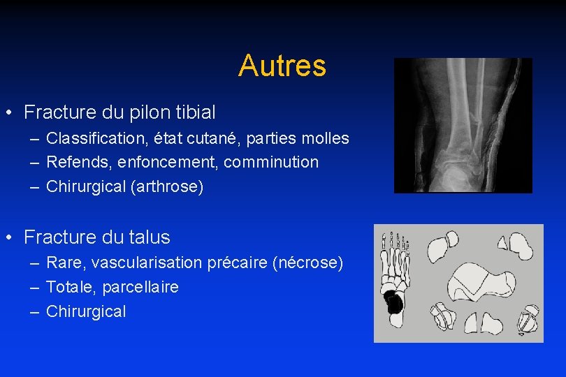 Autres • Fracture du pilon tibial – Classification, état cutané, parties molles – Refends,