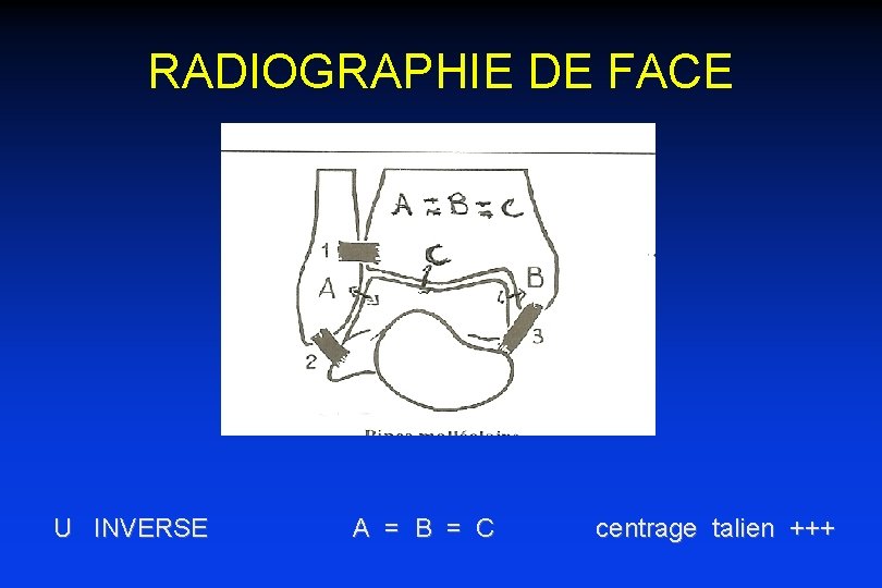 RADIOGRAPHIE DE FACE U INVERSE A = B = C centrage talien +++ 