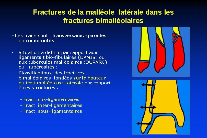 Fractures de la malléole latérale dans les fractures bimalléolaires - Les traits sont :