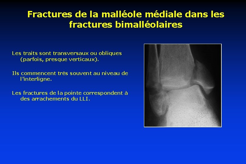 Fractures de la malléole médiale dans les fractures bimalléolaires Les traits sont transversaux ou