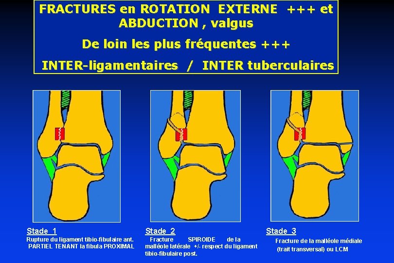 FRACTURES en ROTATION EXTERNE +++ et ABDUCTION , valgus De loin les plus fréquentes