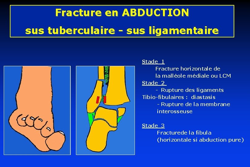 Fracture en ABDUCTION sus tuberculaire - sus ligamentaire Stade 1 Fracture horizontale de la