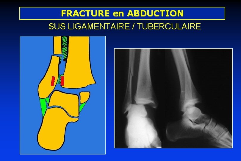 FRACTURE en ABDUCTION SUS LIGAMENTAIRE / TUBERCULAIRE 