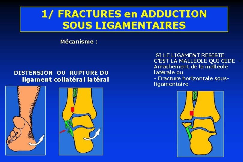 1/ FRACTURES en ADDUCTION SOUS LIGAMENTAIRES Mécanisme : DISTENSION OU RUPTURE DU ligament collatéral