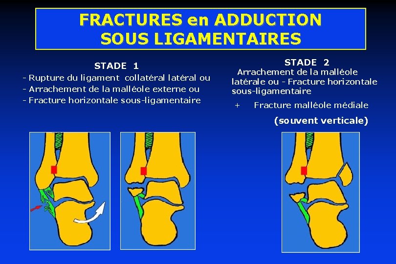 FRACTURES en ADDUCTION SOUS LIGAMENTAIRES STADE 1 - Rupture du ligament collatéral ou -