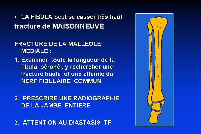  • LA FIBULA peut se casser très haut fracture de MAISONNEUVE FRACTURE DE