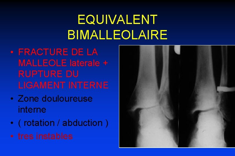 EQUIVALENT BIMALLEOLAIRE • FRACTURE DE LA MALLEOLE laterale + RUPTURE DU LIGAMENT INTERNE •