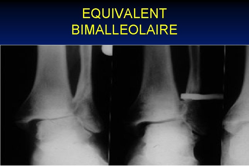 EQUIVALENT BIMALLEOLAIRE 