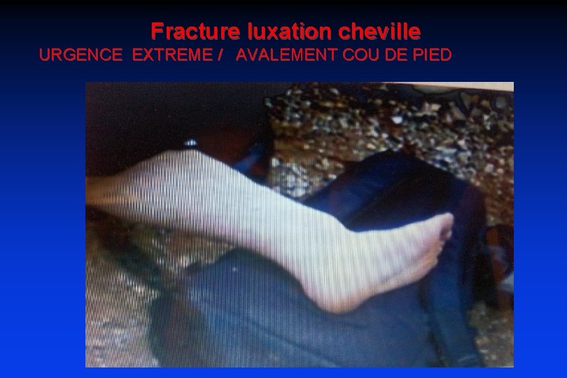 Fracture luxation cheville URGENCE EXTREME / AVALEMENT COU DE PIED 