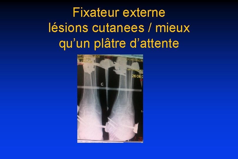 Fixateur externe lésions cutanees / mieux qu’un plâtre d’attente 