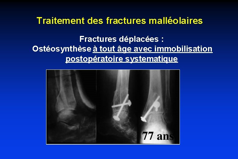 Traitement des fractures malléolaires Fractures déplacées : Ostéosynthèse à tout âge avec immobilisation postopératoire