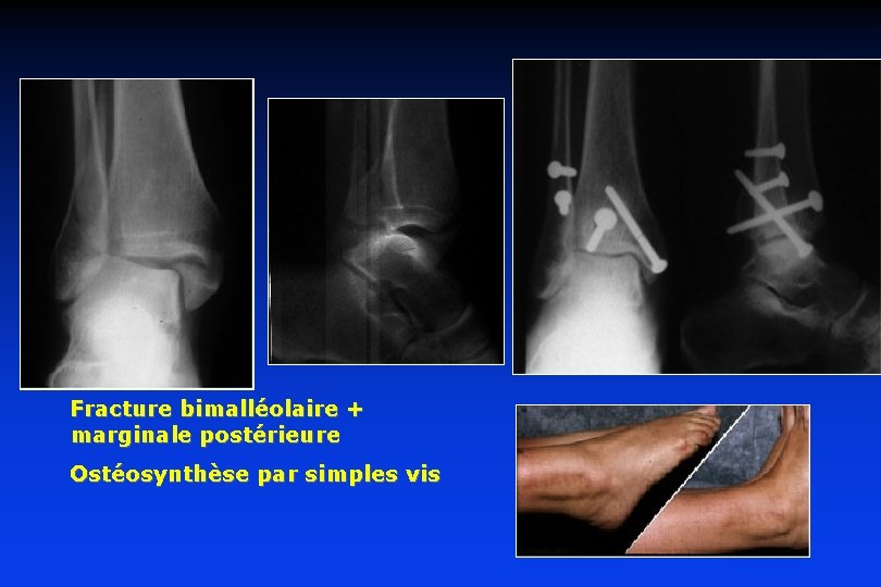 Fracture bimalléolaire + marginale postérieure Ostéosynthèse par simples vis 