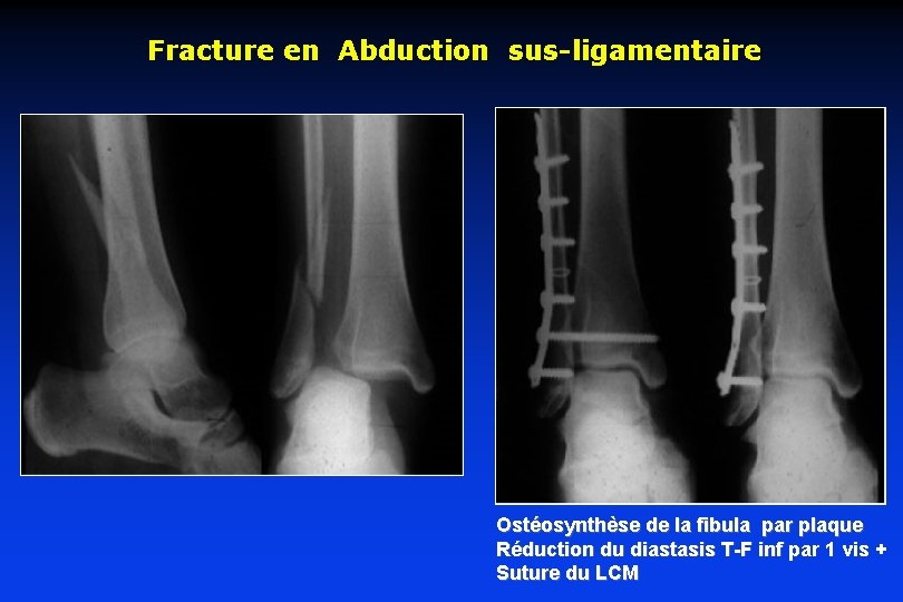 Fracture en Abduction sus-ligamentaire Ostéosynthèse de la fibula par plaque Réduction du diastasis T-F