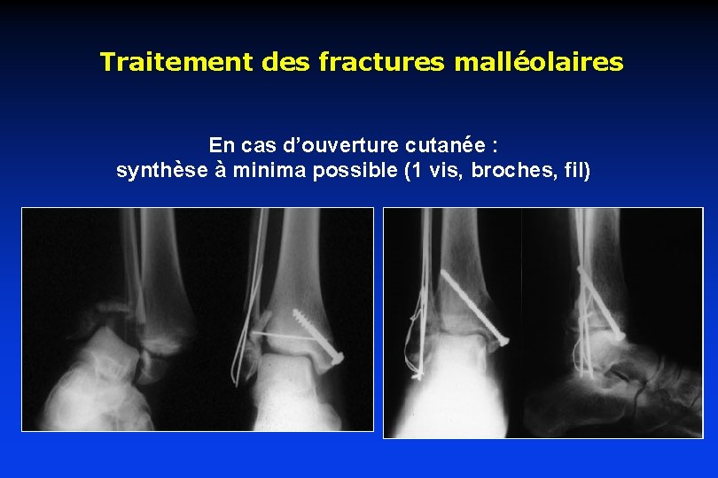 Traitement des fractures malléolaires En cas d’ouverture cutanée : synthèse à minima possible (1