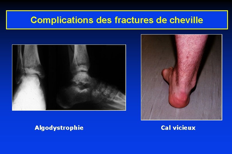 Complications des fractures de cheville Algodystrophie Cal vicieux 