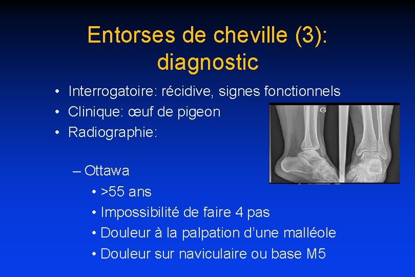 Entorses de cheville (3): diagnostic • Interrogatoire: récidive, signes fonctionnels • Clinique: œuf de