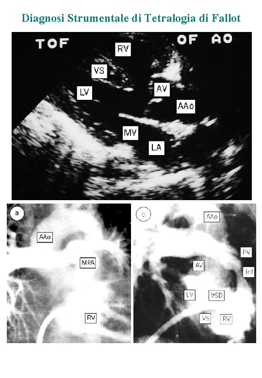 Diagnosi Strumentale di Tetralogia di Fallot 